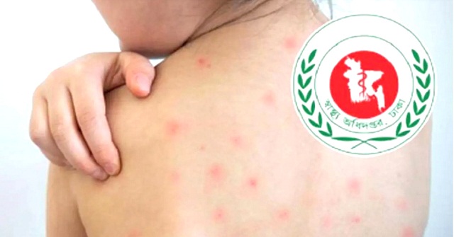 হাম ও হামের উপসর্গ নিয়ে আরও সাতজনের মৃত্যু