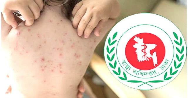 হাম ও হামের উপসর্গে মৃত্যু ৫০০ ছুঁইছুঁই