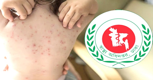 বরিশালে হাম উপসর্গে আরও এক শিশুর মৃত্যু
