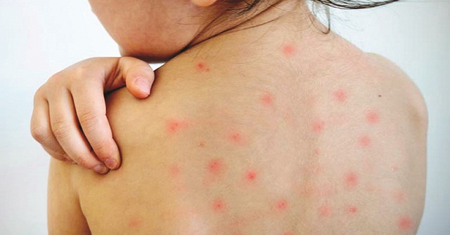 শেবাচিমে হামের উপসর্গ নিয়ে এক শিশুর মৃত্যু, নতুন ভর্তি ৭৮