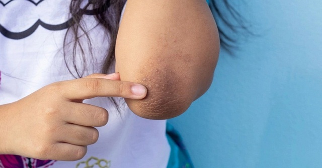 কনুই হাঁটুর কালো দাগ দূর করবেন যেভাবে